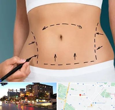 عمل ابدومینوپلاستی در بلوار سجاد مشهد