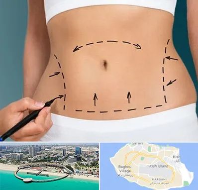 عمل ابدومینوپلاستی در کیش