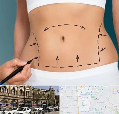 عمل ابدومینوپلاستی در منطقه 11 تهران