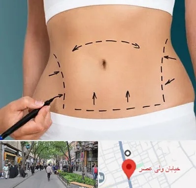 عمل ابدومینوپلاستی در ولیعصر شهریار