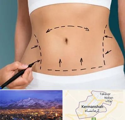 عمل ابدومینوپلاستی در کرمانشاه