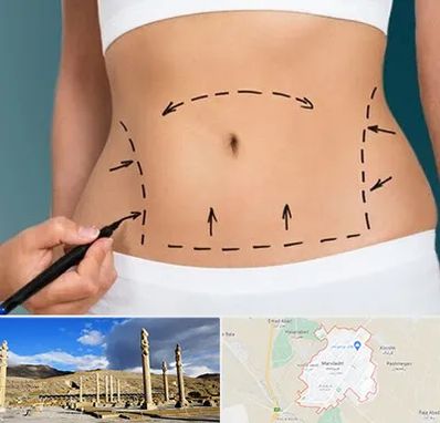 عمل ابدومینوپلاستی در مرودشت