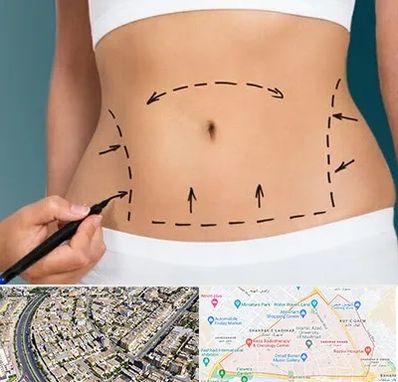 عمل ابدومینوپلاستی در شهرک غرب مشهد