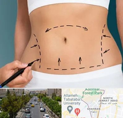 عمل ابدومینوپلاستی در شهران