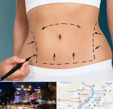 عمل ابدومینوپلاستی در کیانپارس اهواز