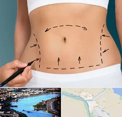 عمل ابدومینوپلاستی در خرمشهر