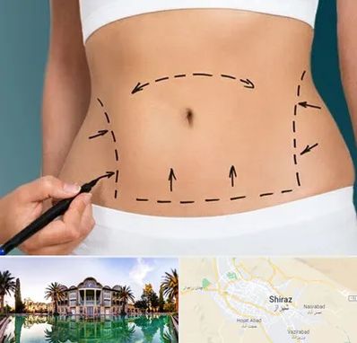 عمل ابدومینوپلاستی در شیراز