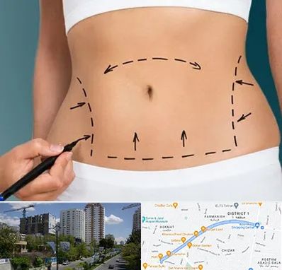 عمل ابدومینوپلاستی در اندرزگو