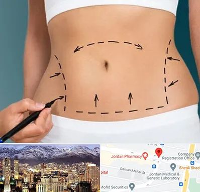 عمل ابدومینوپلاستی در جردن