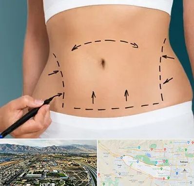 عمل ابدومینوپلاستی در منطقه 21 تهران