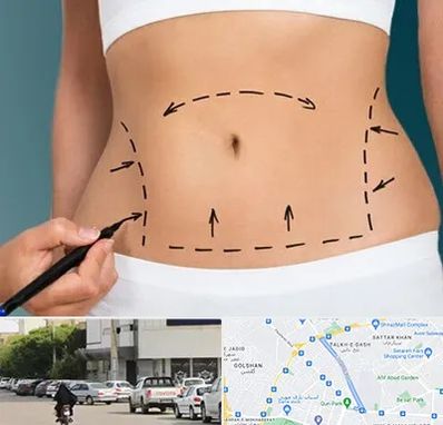 عمل ابدومینوپلاستی در قدوسی شرقی شیراز