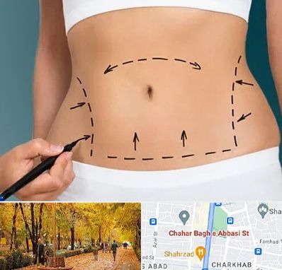 عمل ابدومینوپلاستی در چهارباغ اصفهان