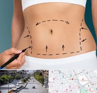 عمل ابدومینوپلاستی در خیابان زند شیراز