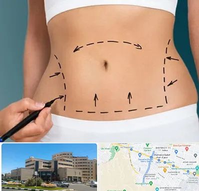 عمل ابدومینوپلاستی در صیاد شیرازی مشهد