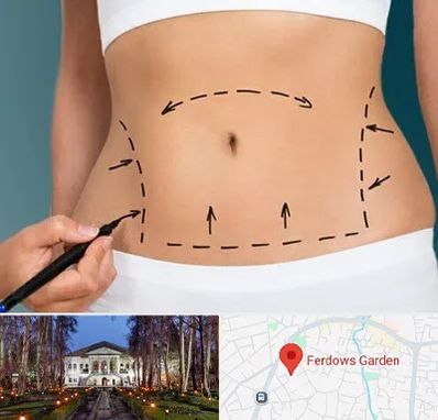 عمل ابدومینوپلاستی در باغ فردوس