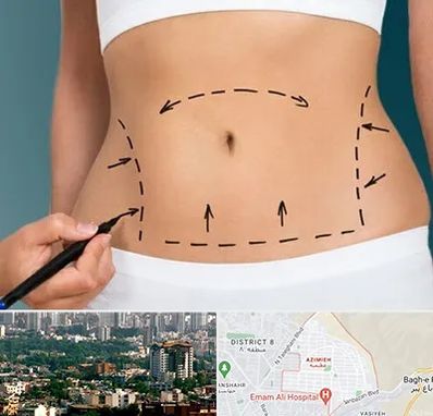 عمل ابدومینوپلاستی در عظیمیه کرج