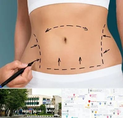 عمل ابدومینوپلاستی در طالقانی