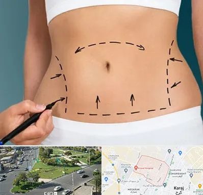 عمل ابدومینوپلاستی در شاهین ویلا کرج