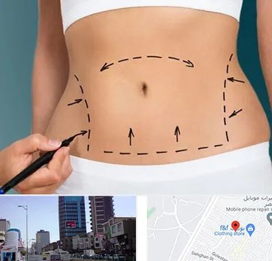 عمل ابدومینوپلاستی در چهارراه طالقانی کرج