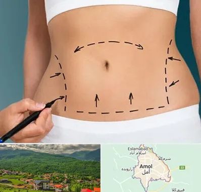 عمل ابدومینوپلاستی در آمل