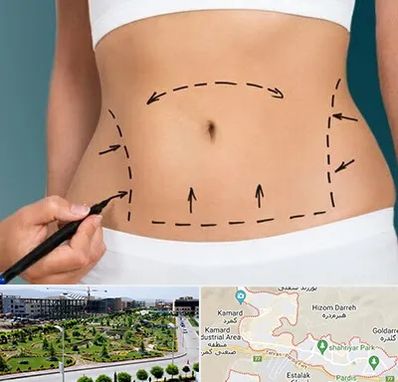 عمل ابدومینوپلاستی در پردیس