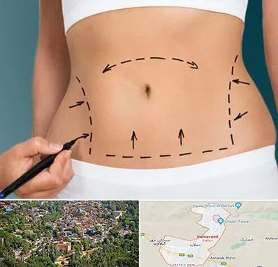 عمل ابدومینوپلاستی در دماوند