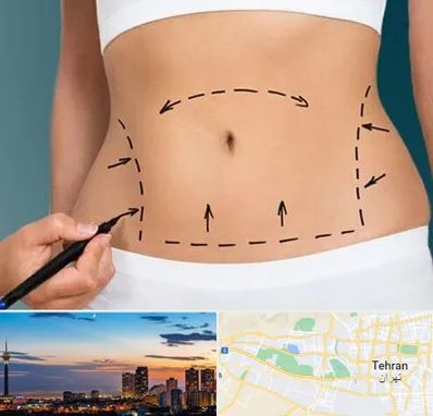 عمل ابدومینوپلاستی در غرب تهران تهران