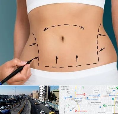 عمل ابدومینوپلاستی در پیروزی