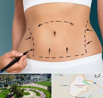عمل ابدومینوپلاستی در مهرشهر کرج