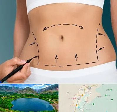 عمل ابدومینوپلاستی در رودبار