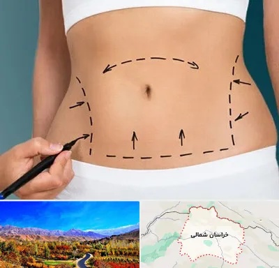 عمل ابدومینوپلاستی در خراسان شمالی