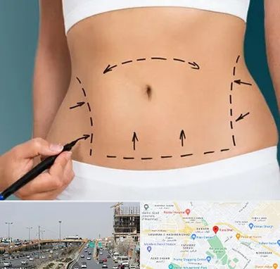 عمل ابدومینوپلاستی در بلوار توس مشهد