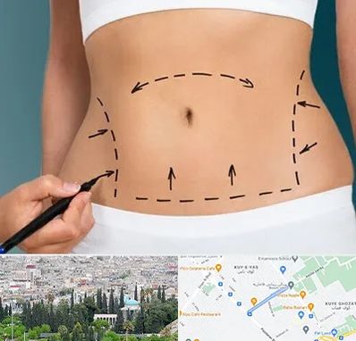 عمل ابدومینوپلاستی در محلاتی شیراز
