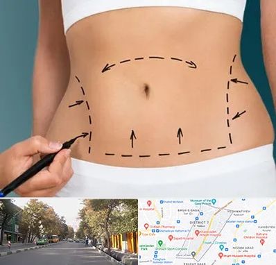 عمل ابدومینوپلاستی در شریعتی