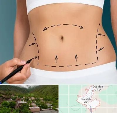 عمل ابدومینوپلاستی در کلاله