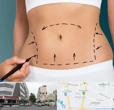 عمل ابدومینوپلاستی در بلوار فردوس