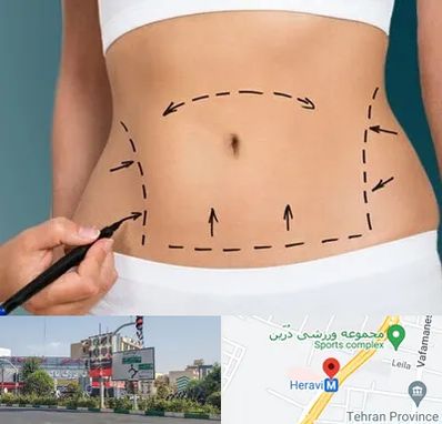 عمل ابدومینوپلاستی در هروی
