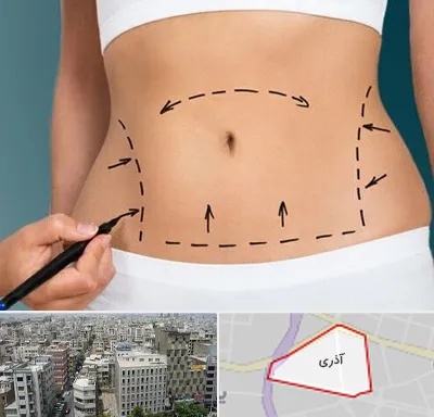 عمل ابدومینوپلاستی در آذری