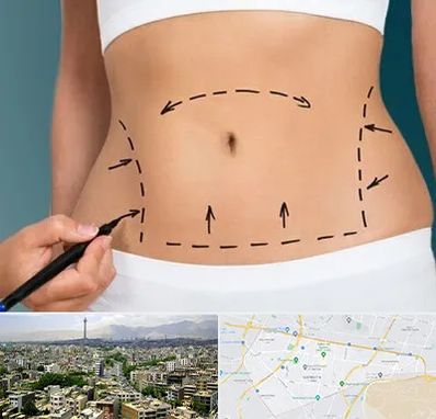 عمل ابدومینوپلاستی در منطقه 8 تهران