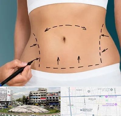 عمل ابدومینوپلاستی در مرکز تهران