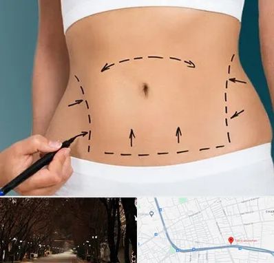 عمل ابدومینوپلاستی در ابوریحان تبریز