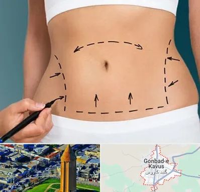 عمل ابدومینوپلاستی در گنبد کاووس