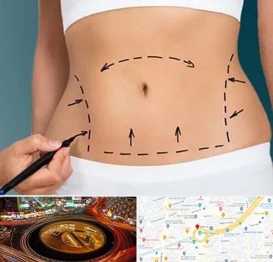 عمل ابدومینوپلاستی در میدان ولیعصر