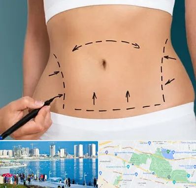 عمل ابدومینوپلاستی در چیتگر