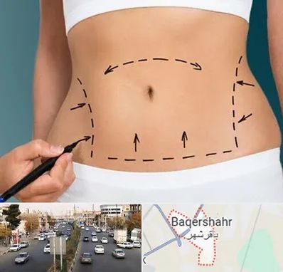 عمل ابدومینوپلاستی در باقرشهر
