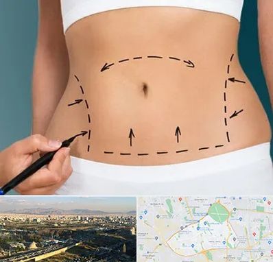 عمل ابدومینوپلاستی در منطقه 19 تهران