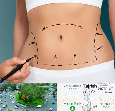 عمل ابدومینوپلاستی در تجریش