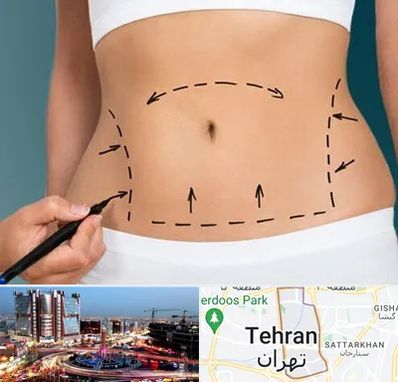 عمل ابدومینوپلاستی در صادقیه تهران