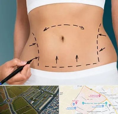 عمل ابدومینوپلاستی در الهیه مشهد