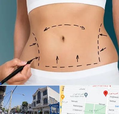 عمل ابدومینوپلاستی در افسریه